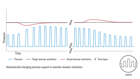 iVAPS (intelligent volume assured pressure support)